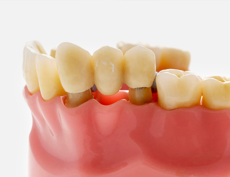 Dental Bridges Image